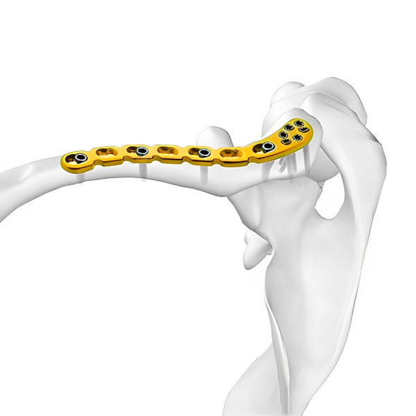 Дистальная ключичная блокирующая пластина