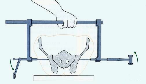 Перелом таза