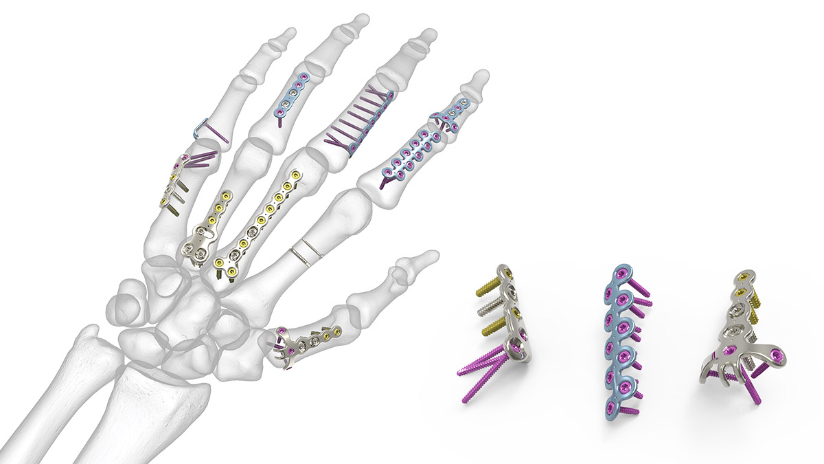 Пястная микропластина 