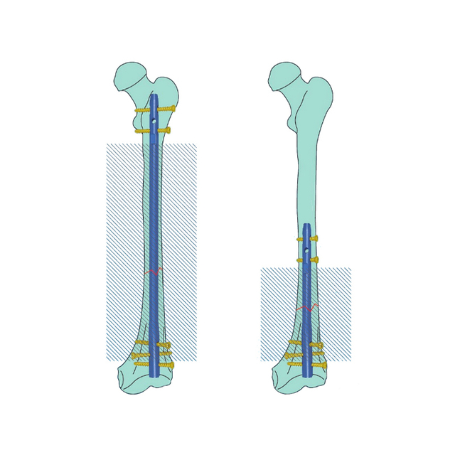 Эксперт поменял бедренную интерлан -интрамедулллярное ногти