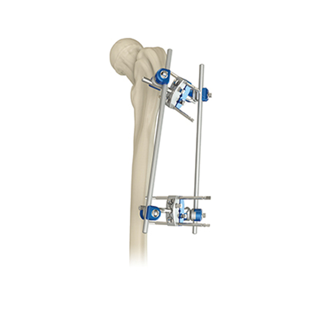 Внешний внешний фиксатор проксима