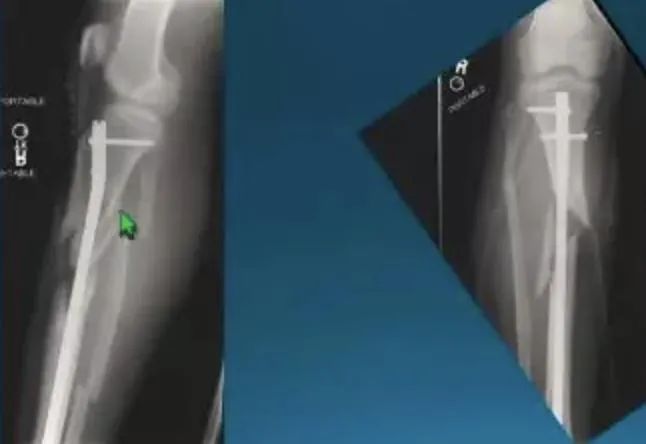 большеберцовый интрамедуллярный