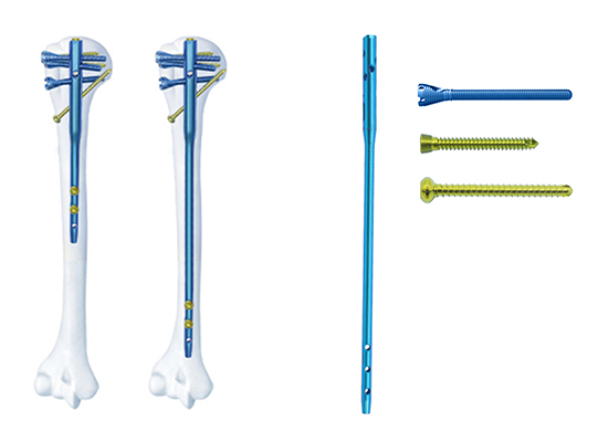 Плечевой интрамедуллярный гвоздь Multi-lock-czmeditech