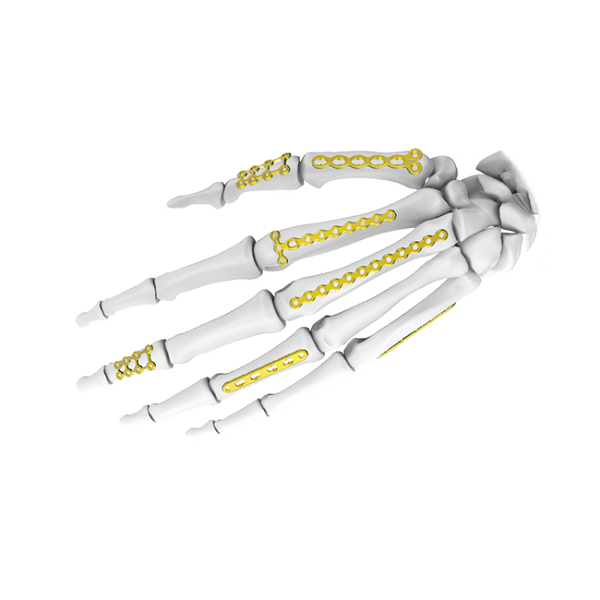 Мини-запорная пластина