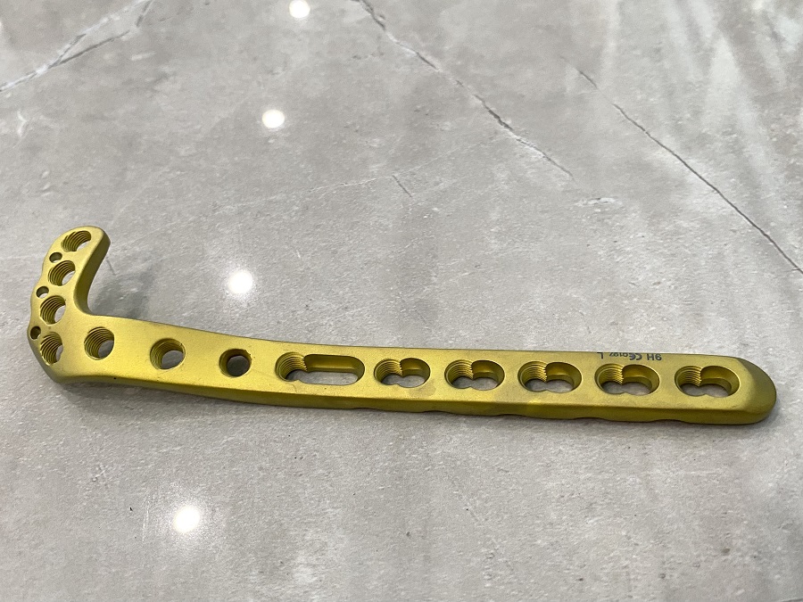 Дистально-латеральная большеберцовая стопорная пластина