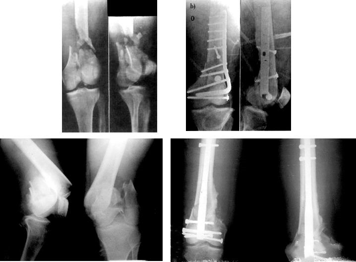 Перелом дистального отдела бедренной кости