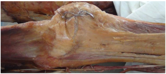 Поперечный перелом надколенника