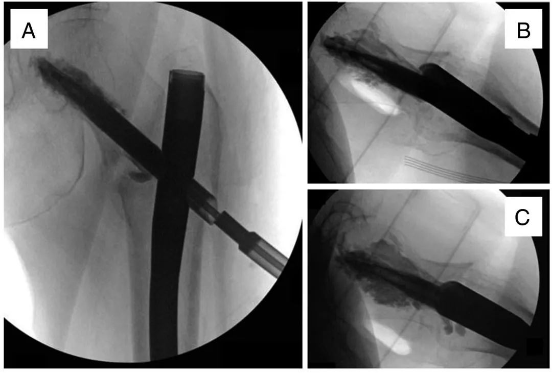 Интрамедуллярный гвоздь