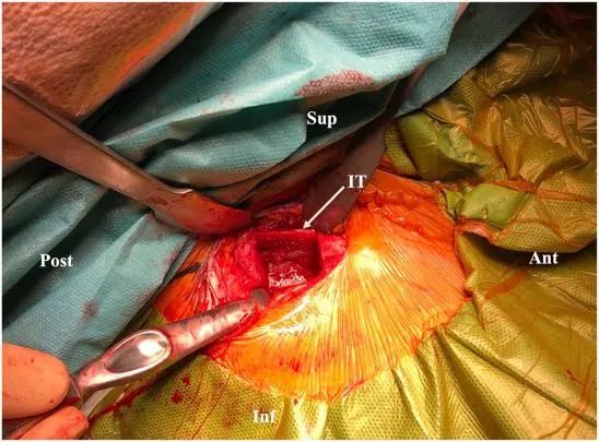Артроскопическое лечение задней нестабильности плечевого сустава