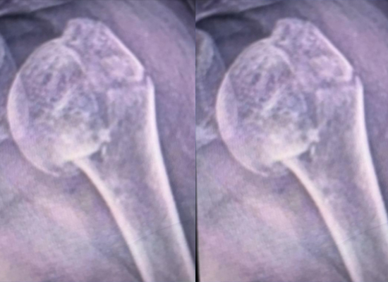 перелом головки плечевой кости предоперационный рентген-czmeditech