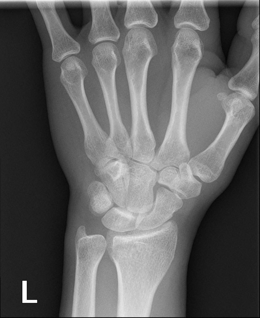 Новые техники фиксации ладонными пластинами переломов дистального отдела лучевой кости