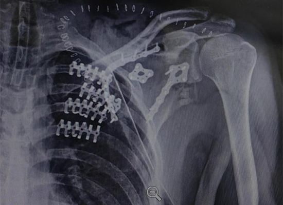 czmeditech-мексика-стабилизация грудной стенки-послеоперационный рентген-01