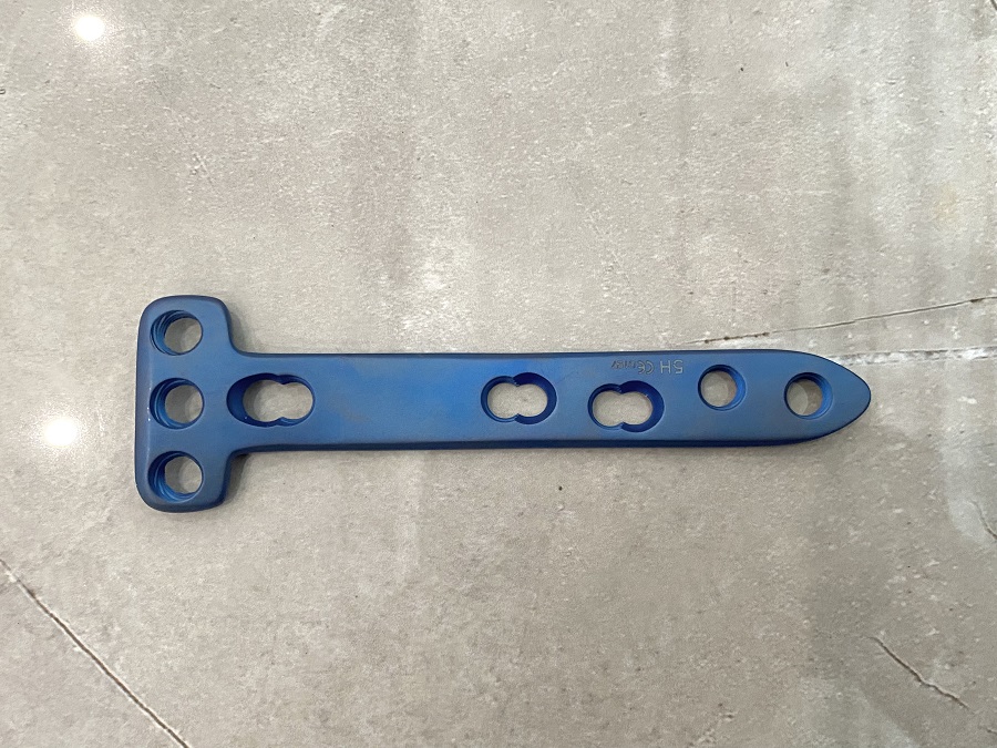 Боковая стопорная пластина большеберцовой головки