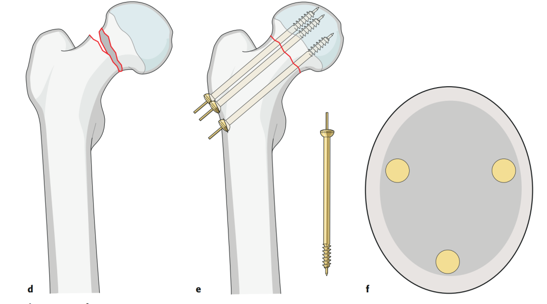 Всестороннее знание плюсов и минусов лечения переломов шейки бедренной кости фиксацией полыми винтами