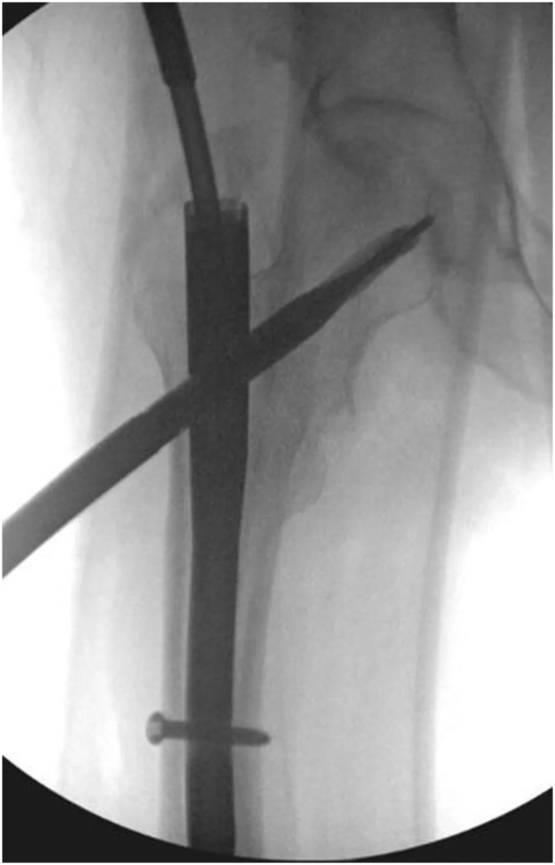 Интрамедуллярный гвоздь