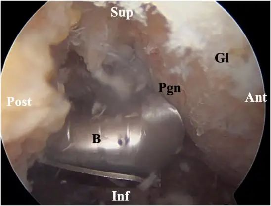 Артроскопическое лечение задней нестабильности плечевого сустава