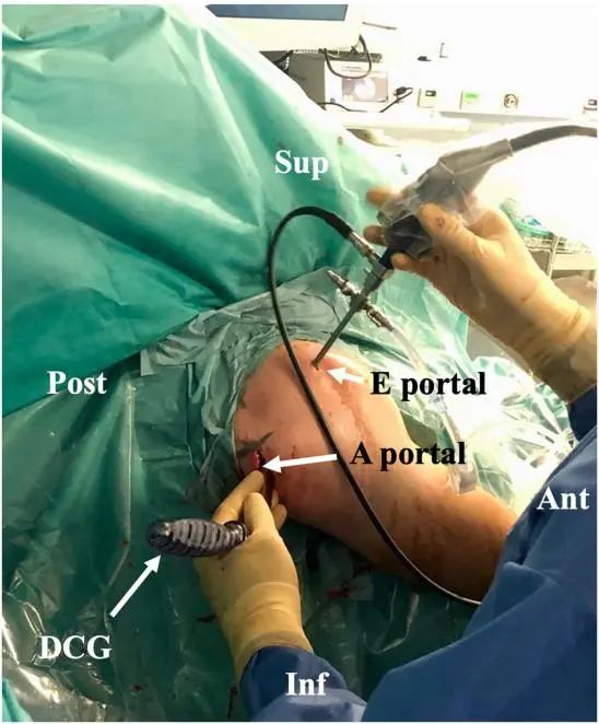 Артроскопическое лечение задней нестабильности плечевого сустава
