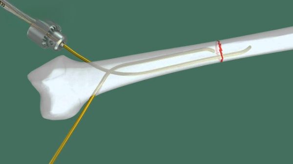 Что такое титановый эластичный гвоздь?