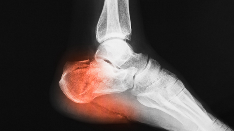 Как лечится перелом пяточной кости?