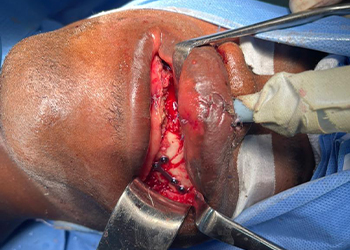 интраоперационный-вид-фиксация-челюстно-лицевой пластины-ghana3-czmeditech