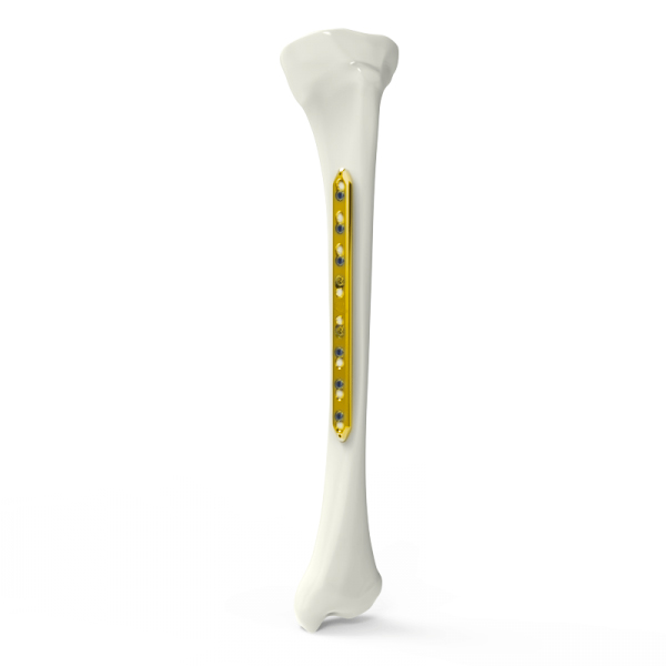 Блокирующая пластина большеберцовой кости узкая