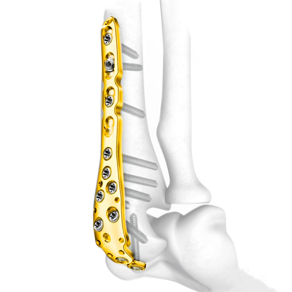 Фиксирующая пластина локтевого отростка