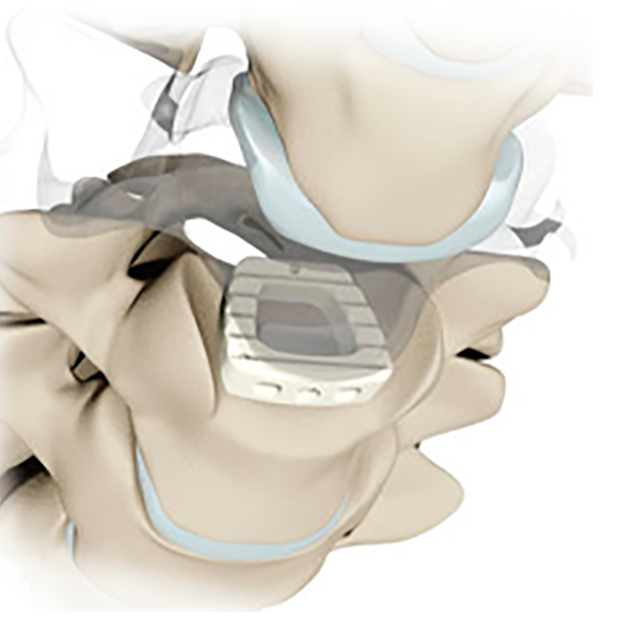 Что такое клетка PEEK?