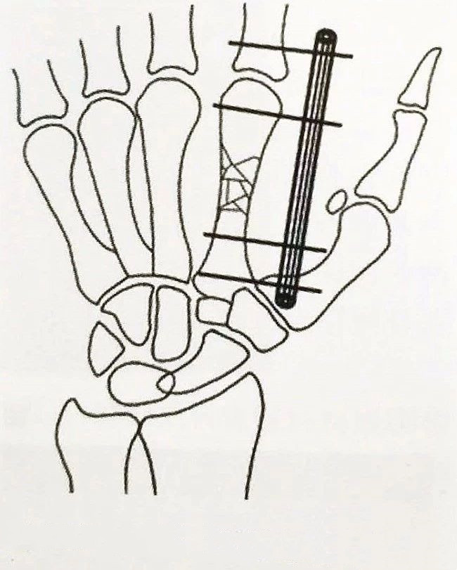 Внешний крепежный кронштейн