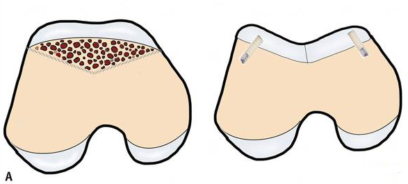 Лечение нестабильности пателлофеморального сустава у детей