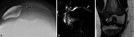Лечение нестабильности пателлофеморального сустава у детей