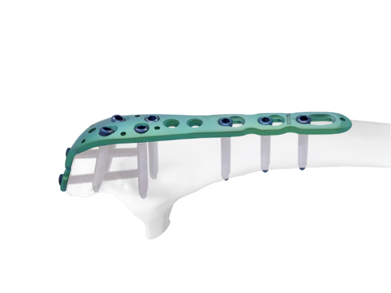 Фиксирующая пластина локтевого отростка: восстановление стабильности и функции локтя