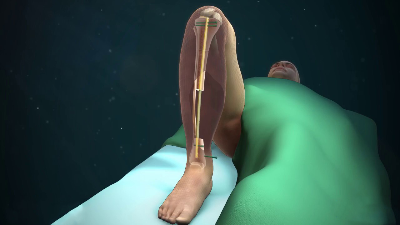 Следует ли удалять интрамедуллярные гвозди?