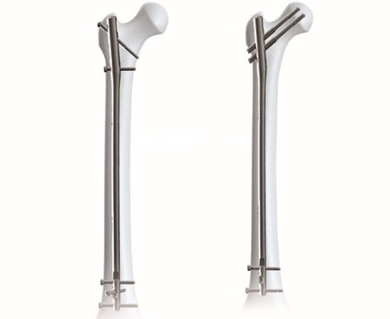 Интрамедуллярный бедренный стержень Expert