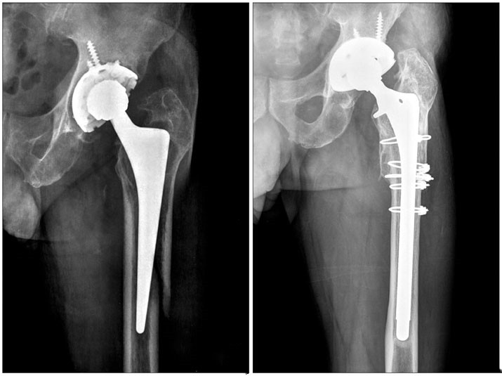 Как лечить перипротезный перелом?