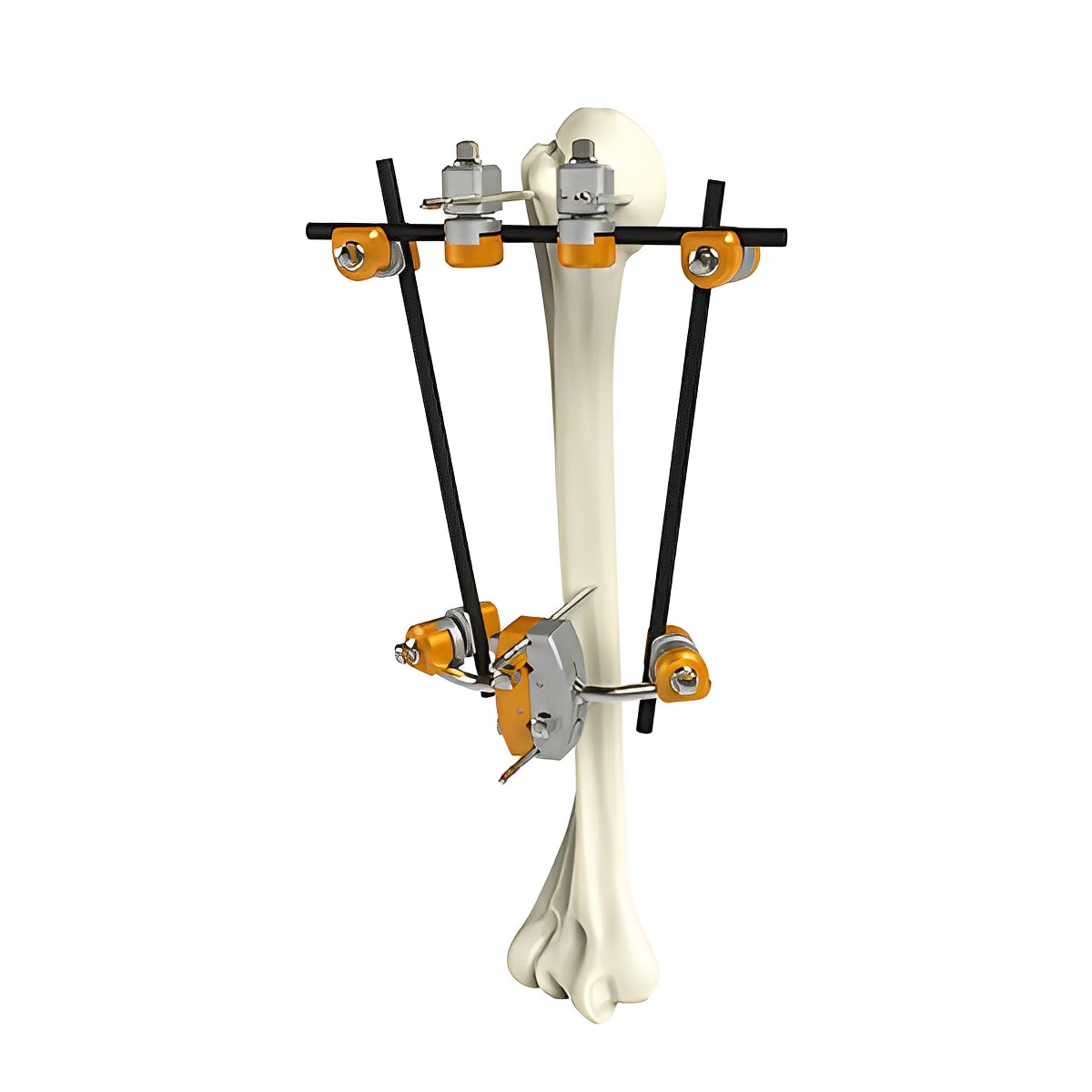 Внешний фиксатор малых фрагментов