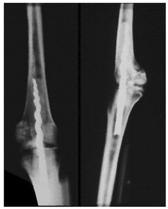 Древние египтяне впервые использовали интрамедуллярное устройство, похожее на гвоздь.Сложная хирургическая помощь при переломах вряд ли существовала так много лет назад.Однако несомненно то, что у древних египтян были отличные методы бальзамирования, основанные на их вере в воскресение тела в загробной жизни.Так было в случае с мумией по имени Усермонту, найденной в гробнице Тутанхамона, где между бедром и большеберцовой костью был вставлен гвоздь с резьбой для стабилизации коленного сустава (как на рис. 2).Археологи предполагают, что мумия внутри саркофага принадлежала не самому Усермонту, а кому-то другому, которого заменили древние грабители гробниц в 600 г. до н.э.2000 лет спустя Бернардино де Саагун, антрополог из экспедиции Эрнандо Кортеса, сообщил о первом применении интрамедуллярного гвоздя у живого пациента в Мексике.В 1524 году он стал свидетелем того, как костный хирург ацтеков (по имени Тезало) выполнил остеотомию с помощью ножа из обсидиана, а затем вставил смоляной стержень в костномозговую полость, чтобы стабилизировать перелом.Из-за отсутствия адекватной хирургической техники и антисептики эти процедуры имели высокую частоту осложнений и высокую летальность.