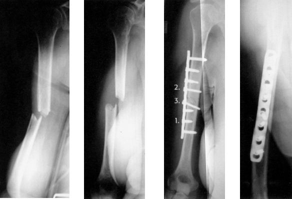 Перелом плечевой кости
