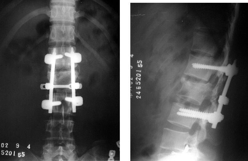 Перелом позвоночника