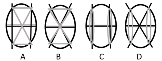 Перелом надколенника