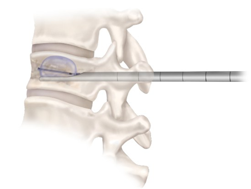 Кифопластика баллоном