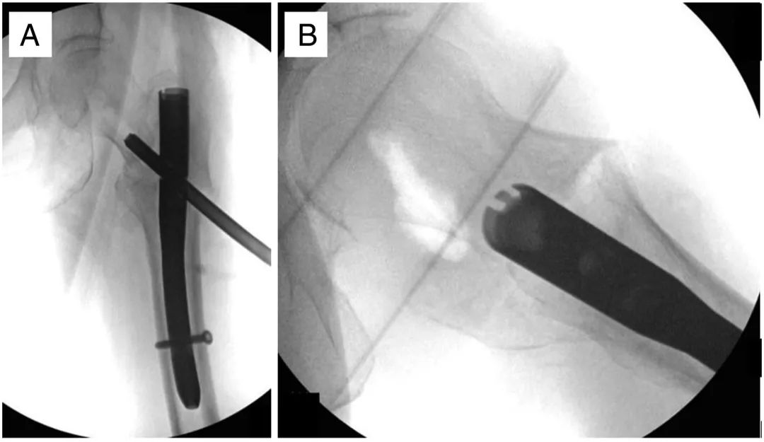 Интрамедуллярный гвоздь