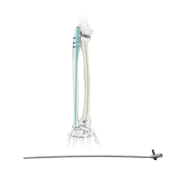 Радиус интрамедуллярный гвоздь