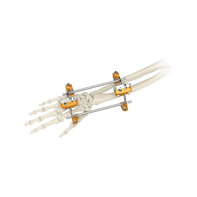 Внешний фиксатор UINA & RADIUS