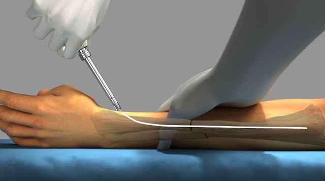 Как удалить интрамедуллярный гвоздь?