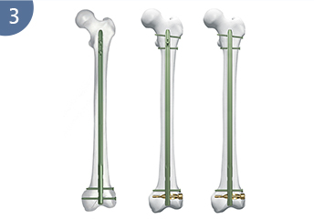 Эксперт Р/Афн.Ретроградный/антеградный бедренный гвоздь