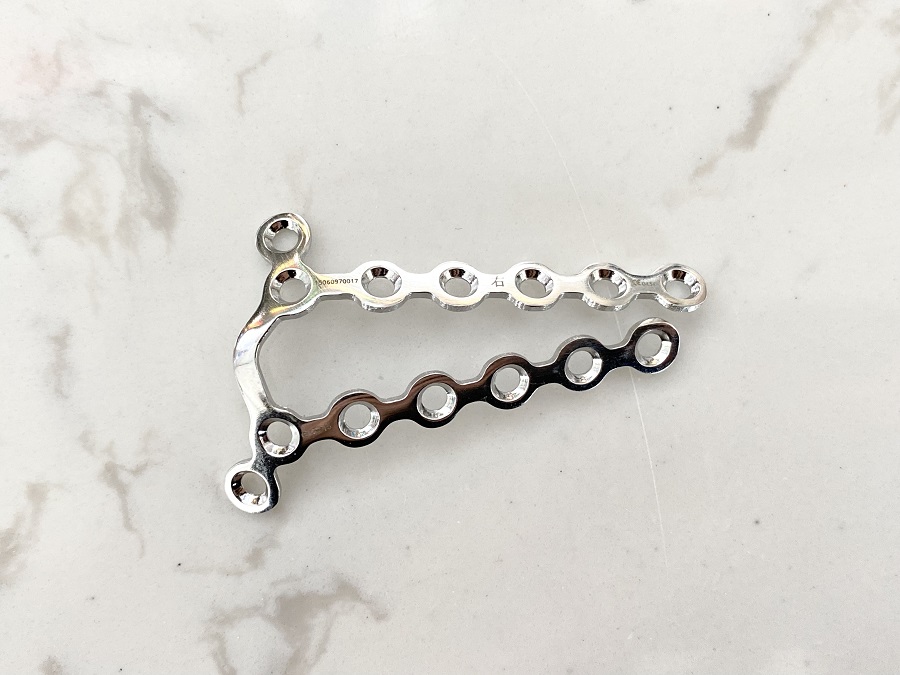 Дистальная радиальная задняя пластина