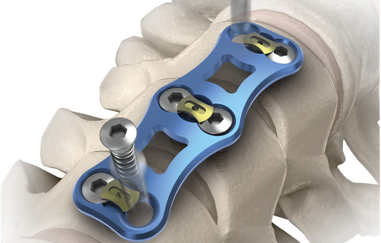 Ортопедический-имплантат-Шейный-Позвонок-Передняя-Титановые-Пластины-III_副本_副本
