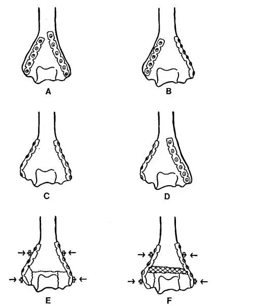 Переломы дистального отдела плечевой кости