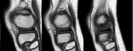 дисковидный латеральный мениск1