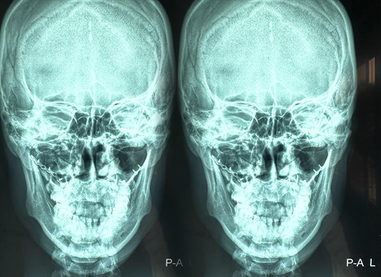 послеоперационный результат-челюстно-лицевая фиксация-плечевой головки